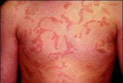 Obat Kaligata Tradisional